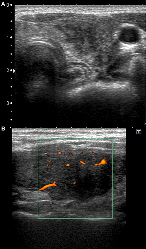 thyroiditis ultrasound pictures