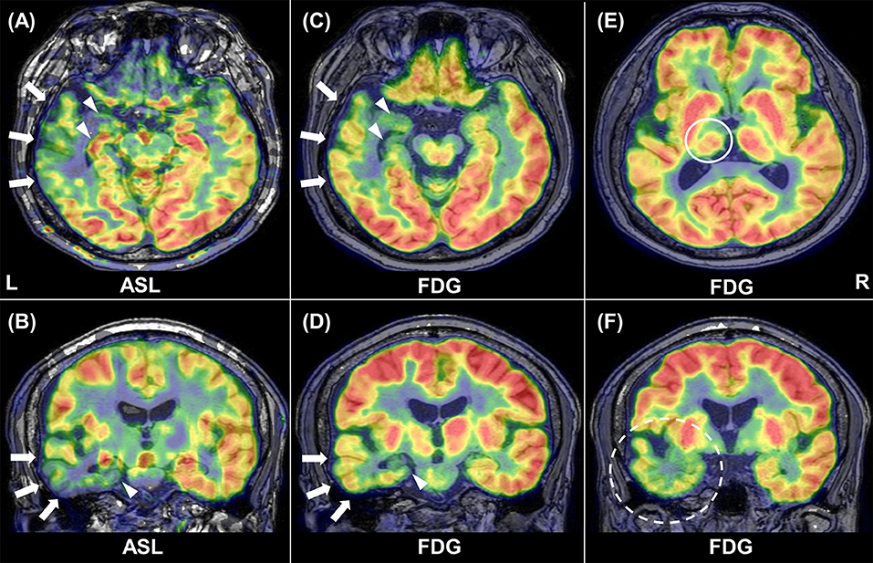 brain pet scan epilepsy