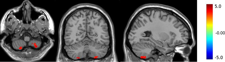 Frontiers | Altered Functional Connectivity Between the Cerebellum and ...