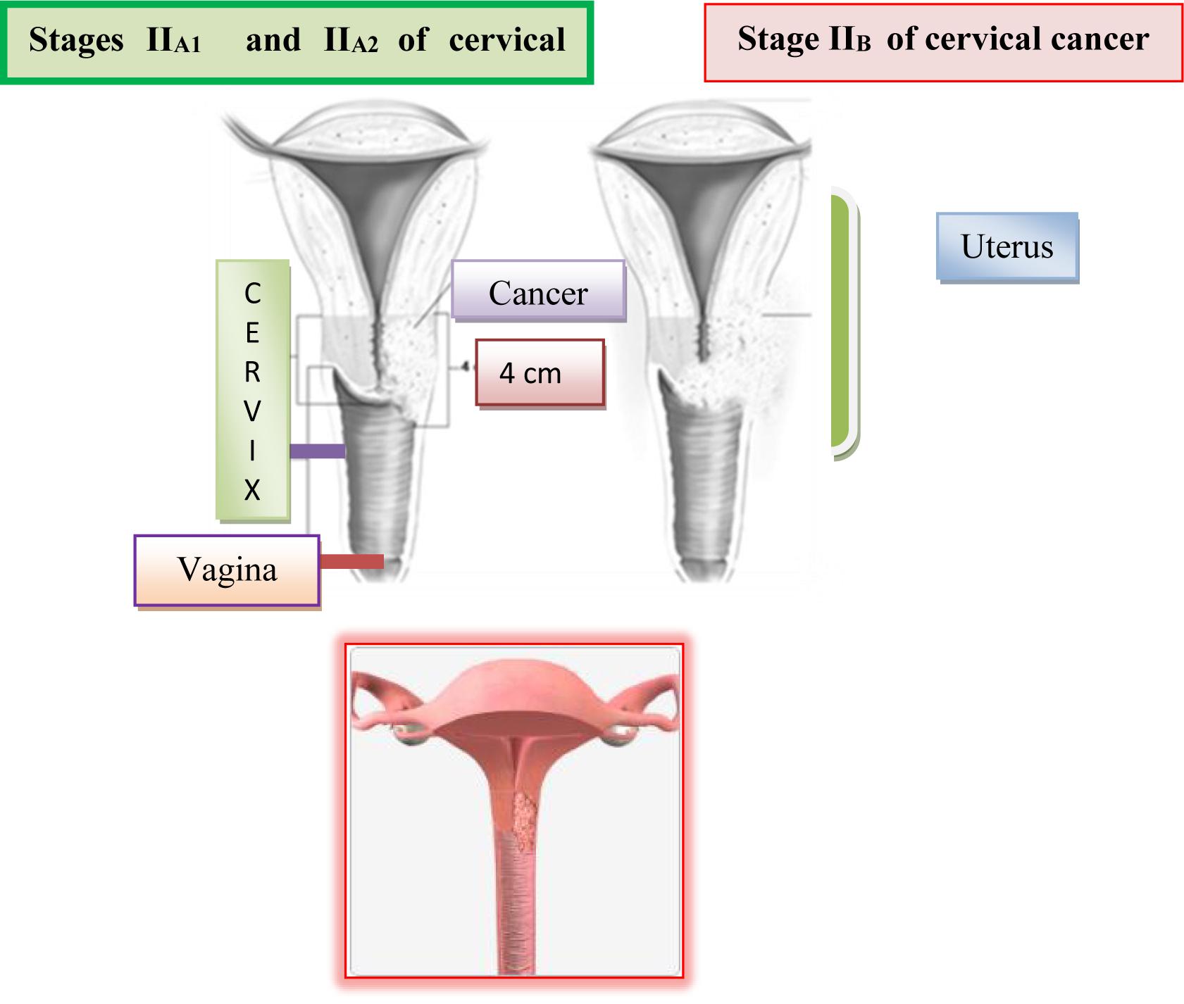 Second Stage of Cervical Cancer 