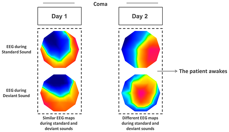 Figure 2 - We recorded brain responses from a patient on the first and second day of coma.