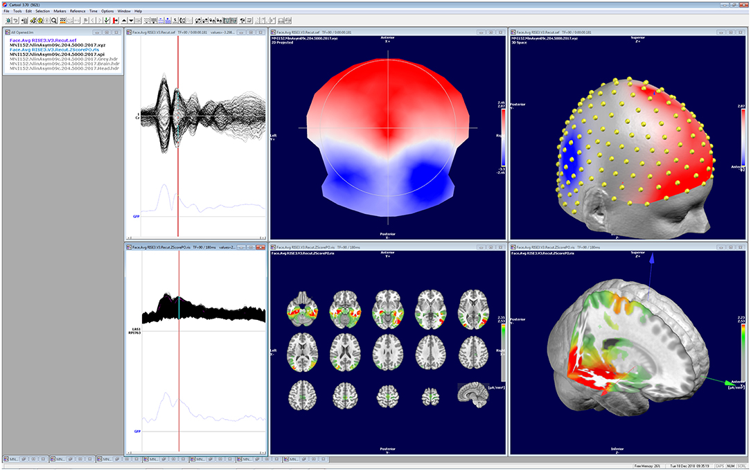 PDF) A test of brain electrical source analysis (BESA): A simulation study