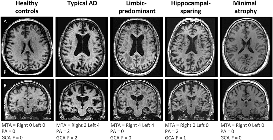 Alzheimer`s - Mind Map