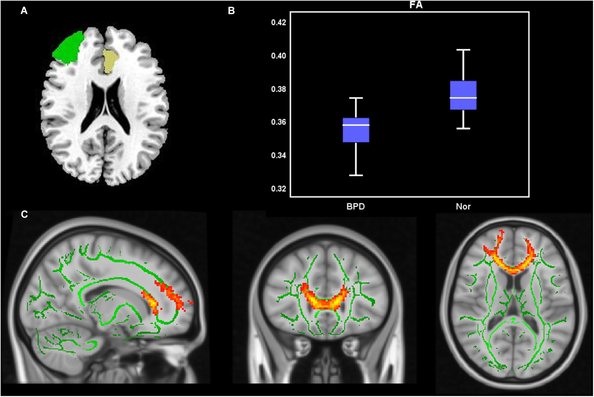 Cureus, Structural MRI Brain Alterations in Borderline Personality Disorder  and Bipolar Disorder