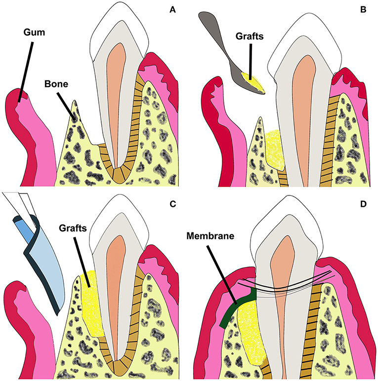 Frontiers | advance of nano-composite electrospun fibers in periodontal