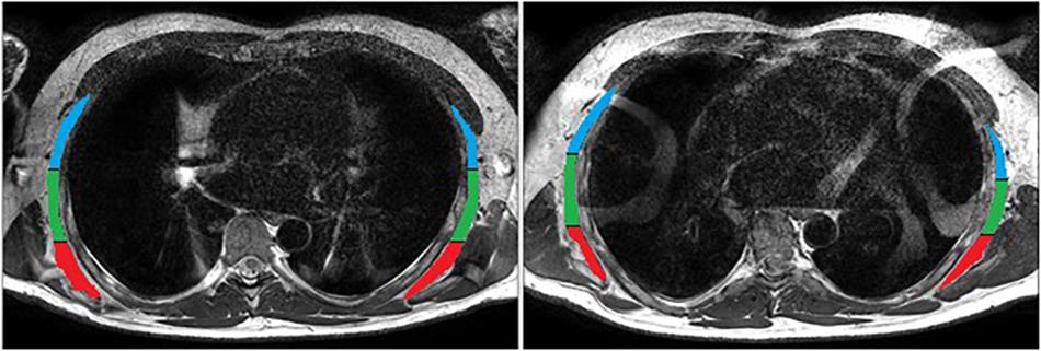 Frontiers | Serratus Anterior Contraction During Resisted Arm Extension