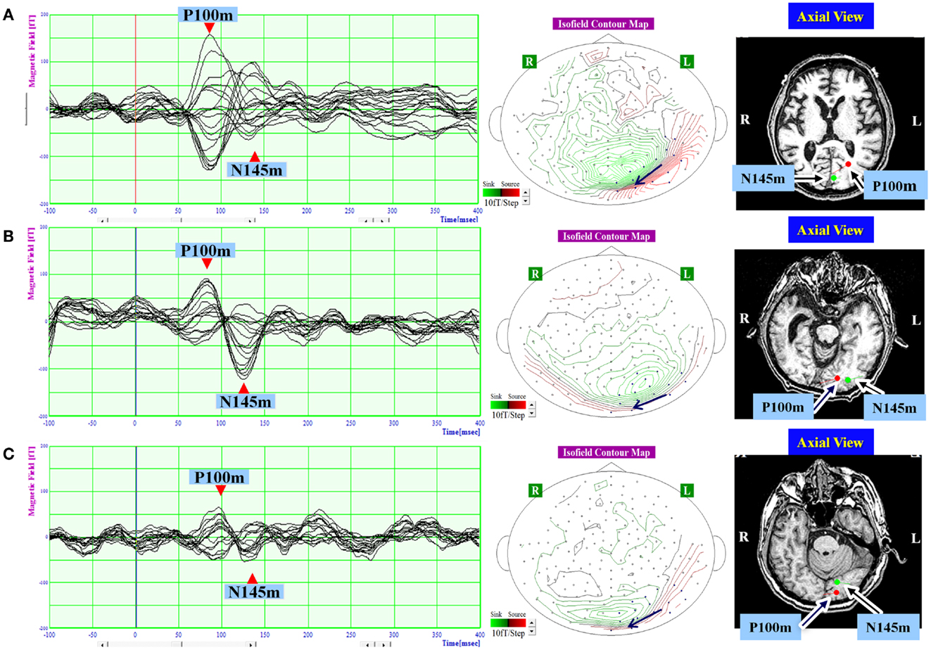 Frontiers | Early Visual Processing is Affected by Clinical
