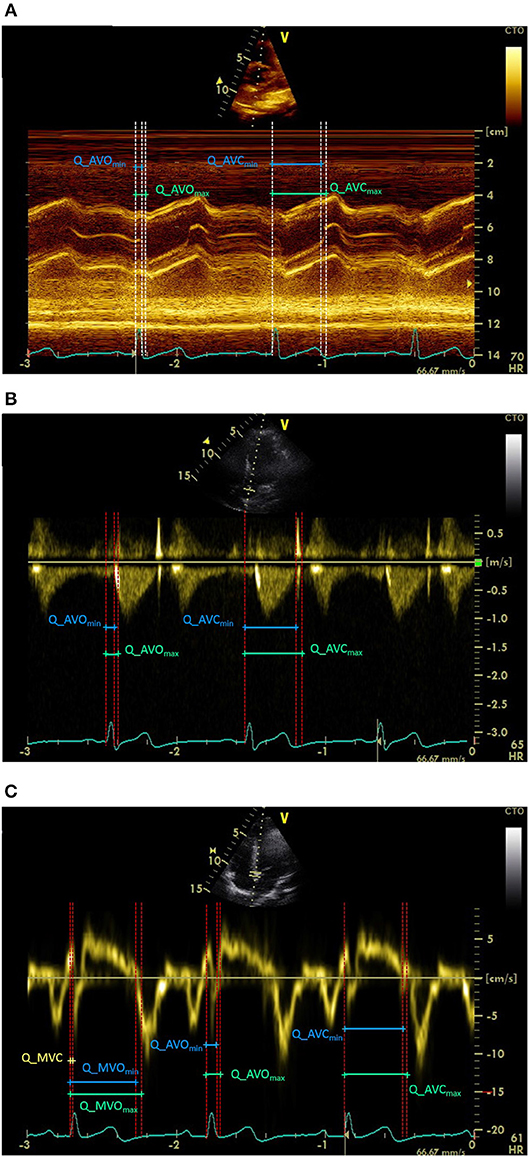 Frontiers Comparison of Different Methods for Cardiac Timings: A Echocardiography Investigation
