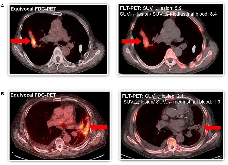 Frontiers | FLT-PET-CT for the Detection of Disease Recurrence After ...