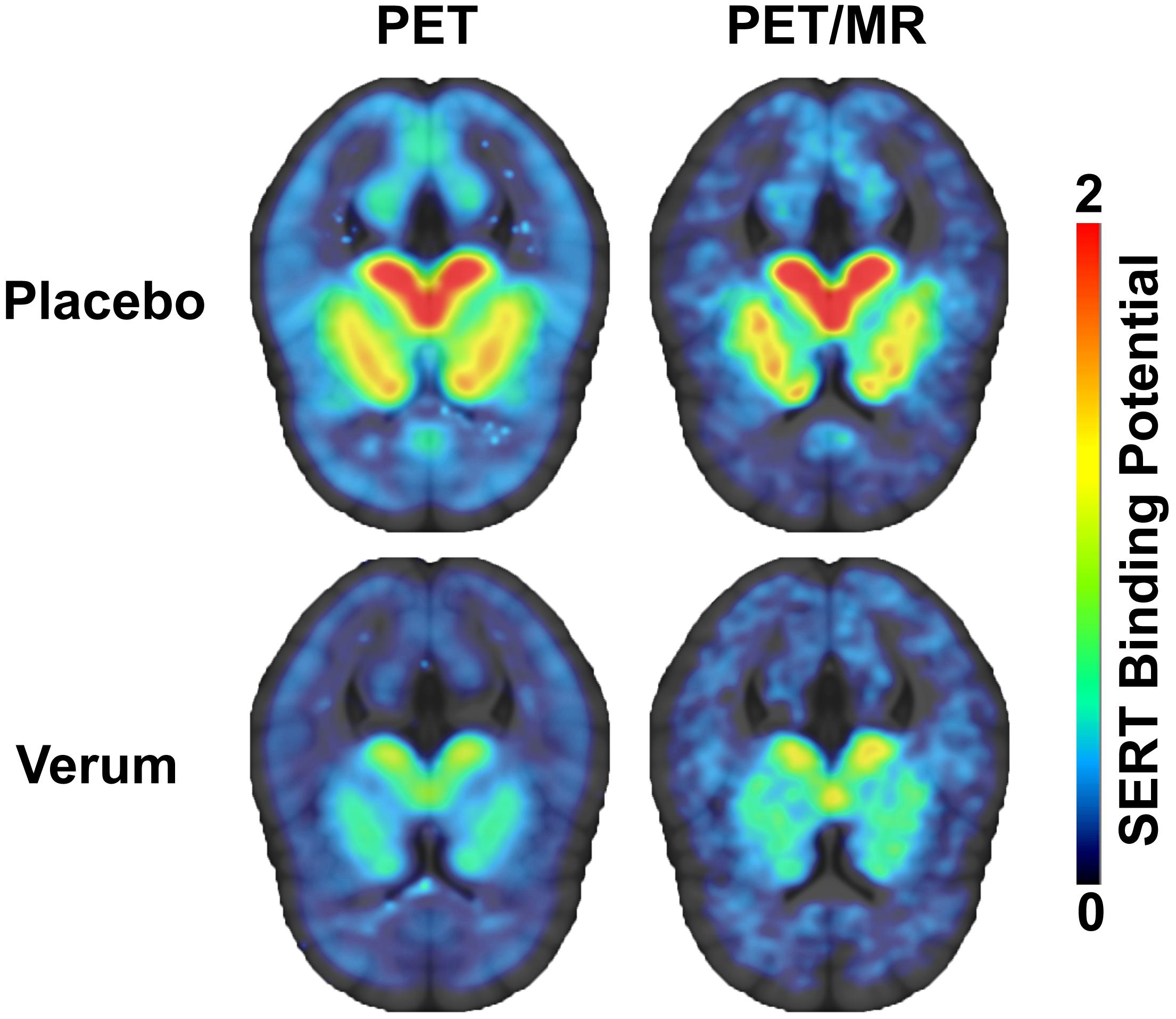 Brain PET scan