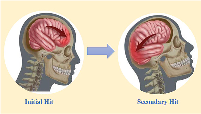 Figure 2 - One hit can damage two parts of the brain: the coup and countercoup model.