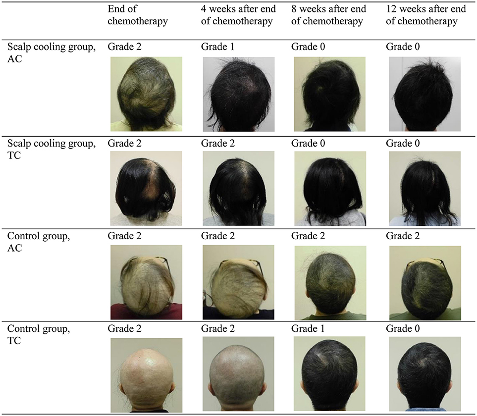 Frontiers | Efficacy of Scalp Cooling in Preventing and Recovering From  Chemotherapy-Induced Alopecia in Breast Cancer Patients: The HOPE Study