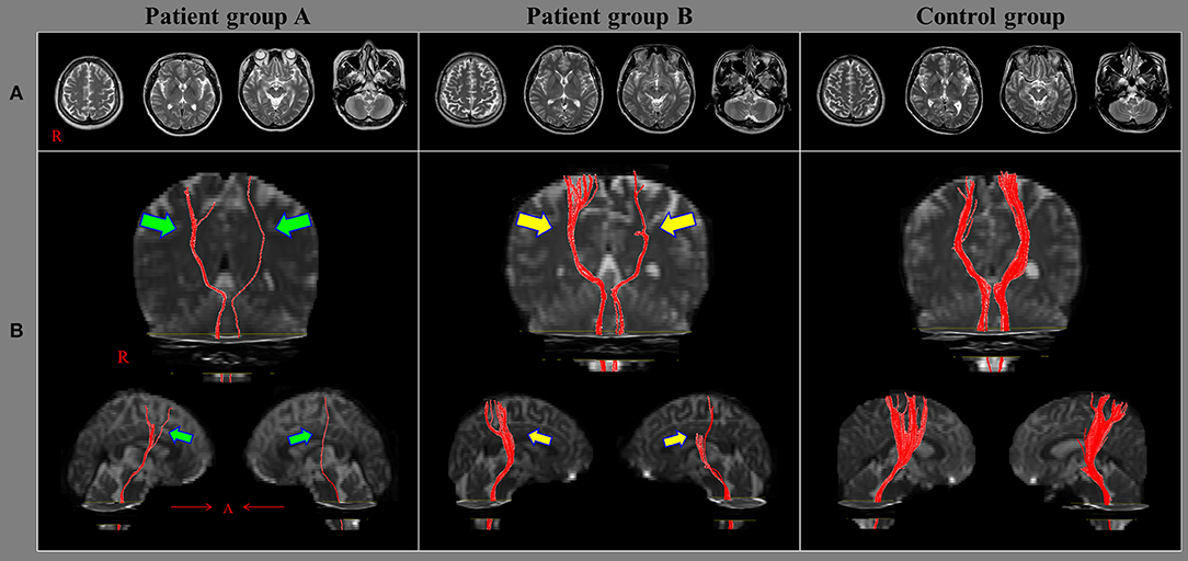 Diffusion Tensor Imaging in Traumatic Brain Injury, Neuropsychology