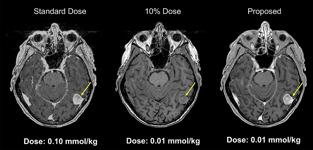 Neuroimaging and deep learning for brain stroke detection - A review of  recent advancements and future prospects - ScienceDirect