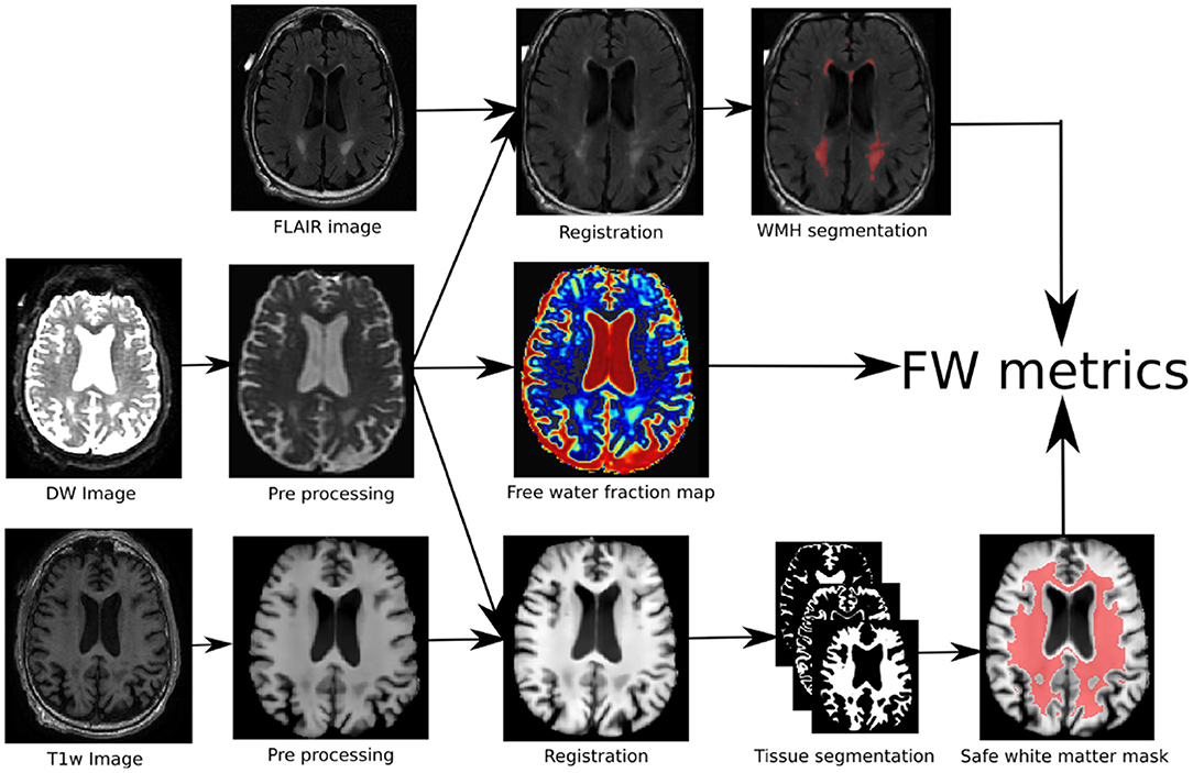 Frontiers | Free Water in White Matter Differentiates MCI and AD 