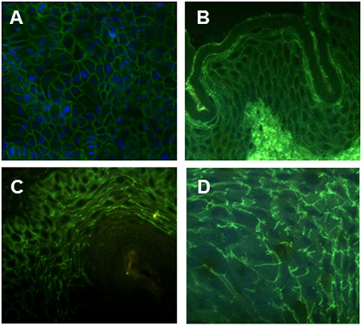 Pemphigus Vulgaris Immunofluorescence