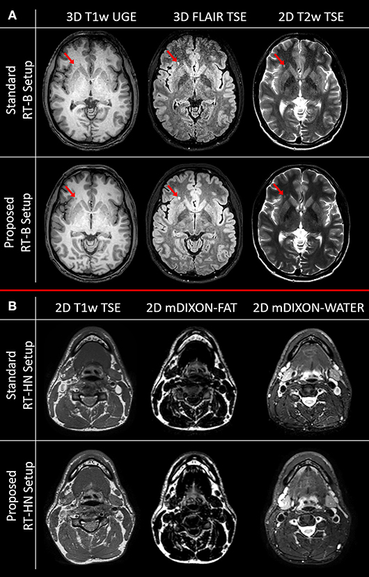 Frontiers | Brain and Head-and-Neck MRI in Immobilization