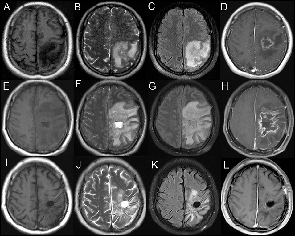 Frontiers Primary Angiitis of the Central Nervous System Mim