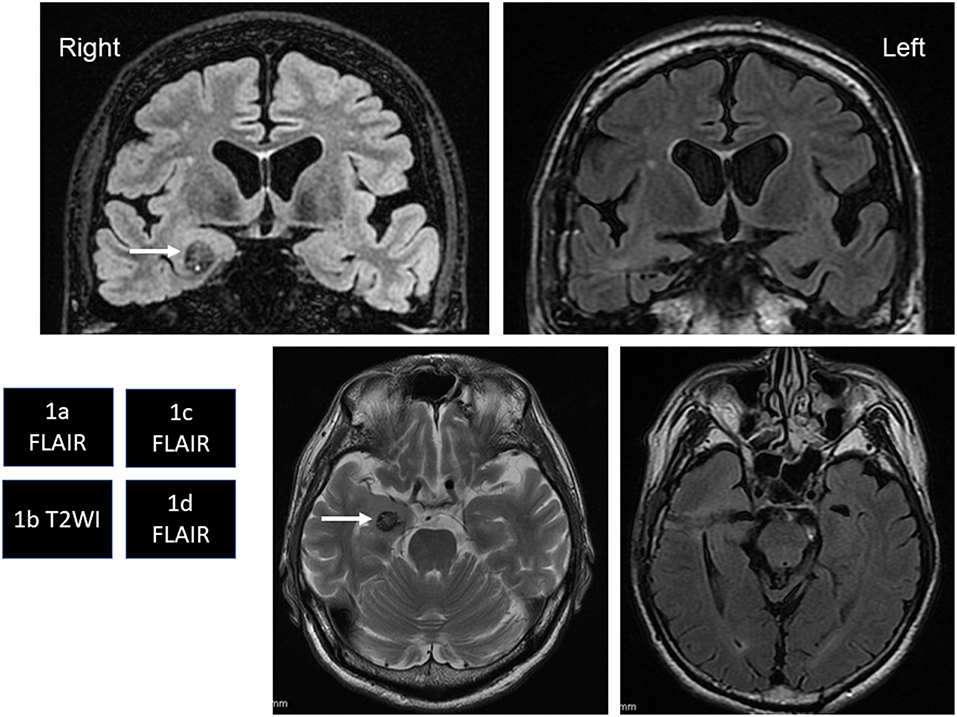 case studies of transient epileptic amnesia