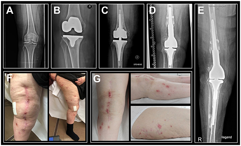 Frontiers | Diagnosis of Metal Hypersensitivity in Total Knee Arthroplasty: A Case Report ...