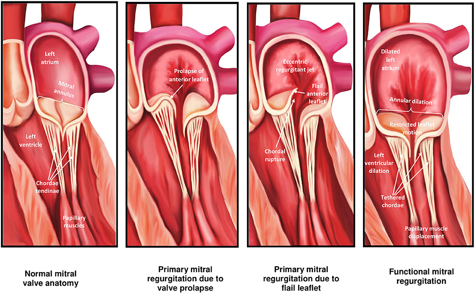 Mitral Valve Regurgitation Symptoms Slideshare