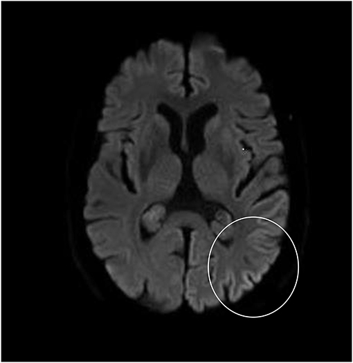 Frontiers Alice In Wonderland Syndrome As A Presenting Manifestation Of Creutzfeldt Jakob Disease Neurology