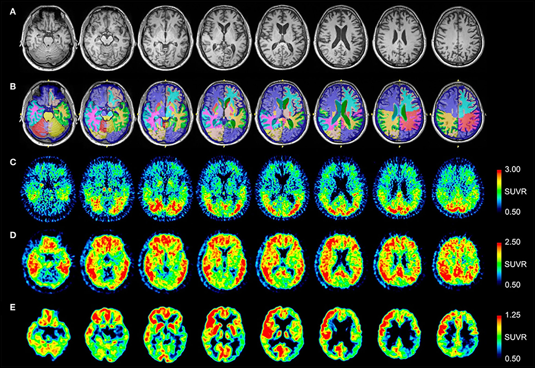 Frontiers | [18F]FDG, [11C]PiB, and [18F]AV-1451 PET Imaging of Neurodegeneration Two Subjects With a History of Repetitive Trauma Cognitive Decline
