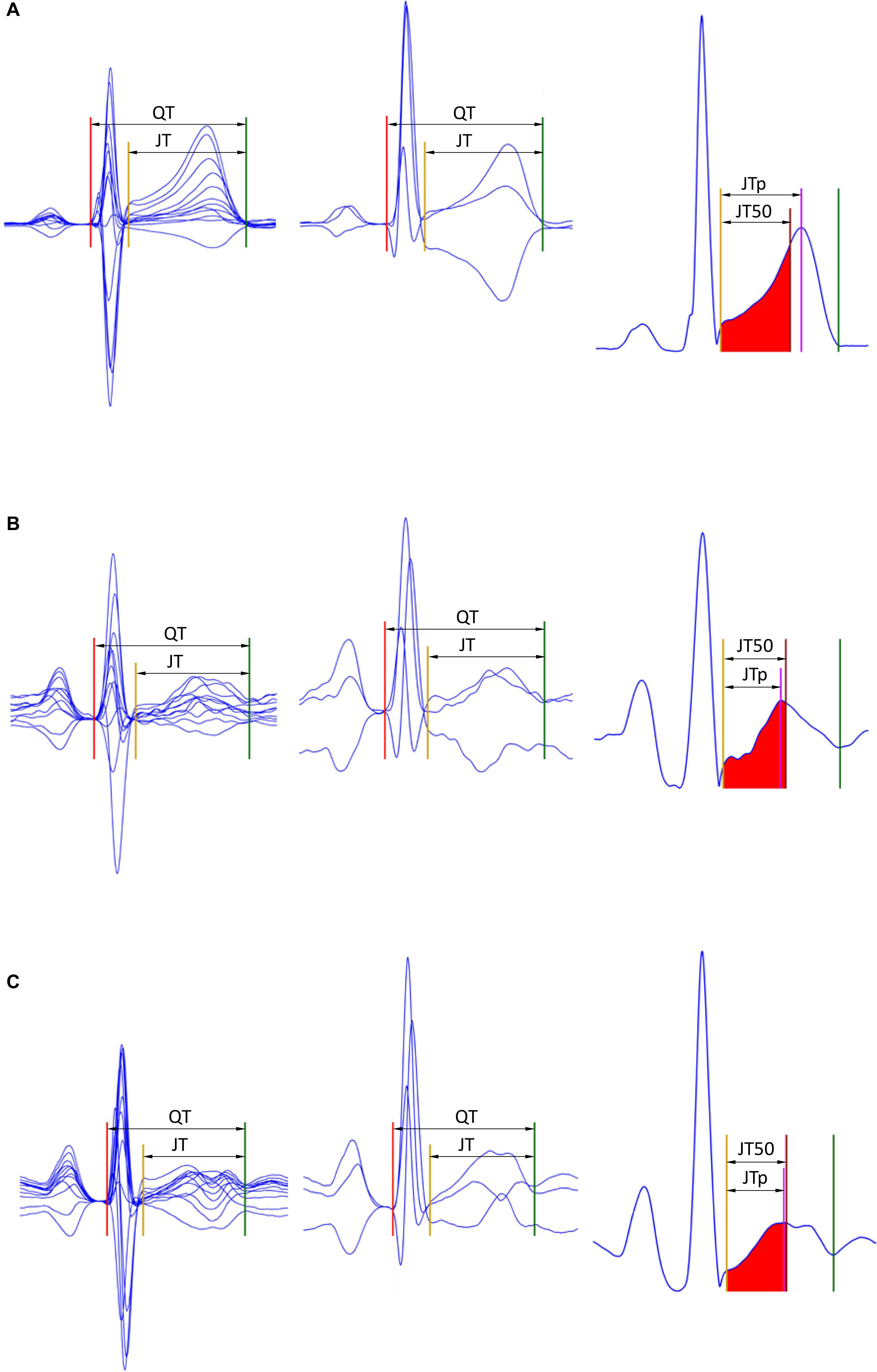 Frontiers Detection Of T Wave Peak For Serial Comparisons Of Jtp Interval Physiology