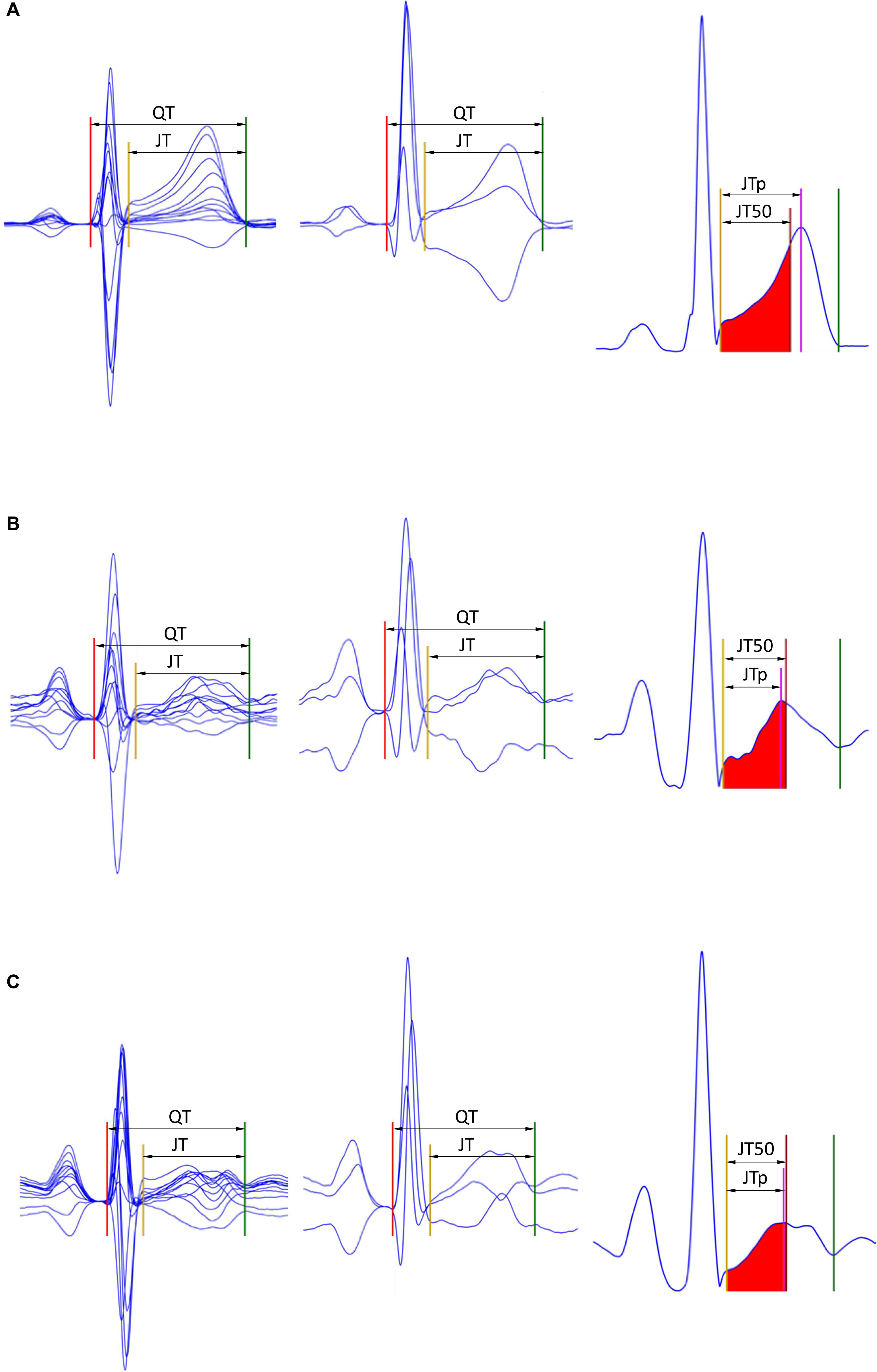 Frontiers Detection Of T Wave Peak For Serial Comparisons Of Jtp Interval Physiology Frontiers Detection Of T Wave Peak For Serial Comparisons Of Jtp Interval Physiology