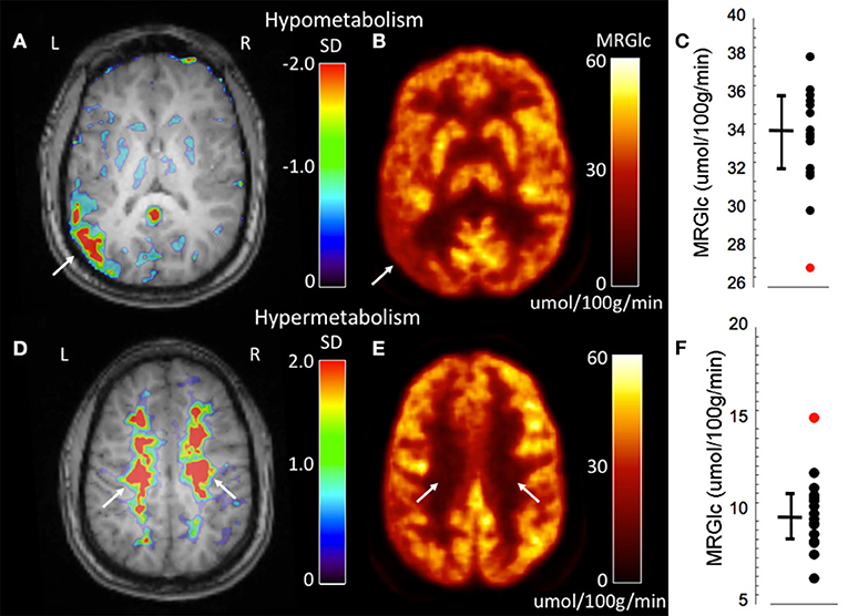 brain pet scan epilepsy