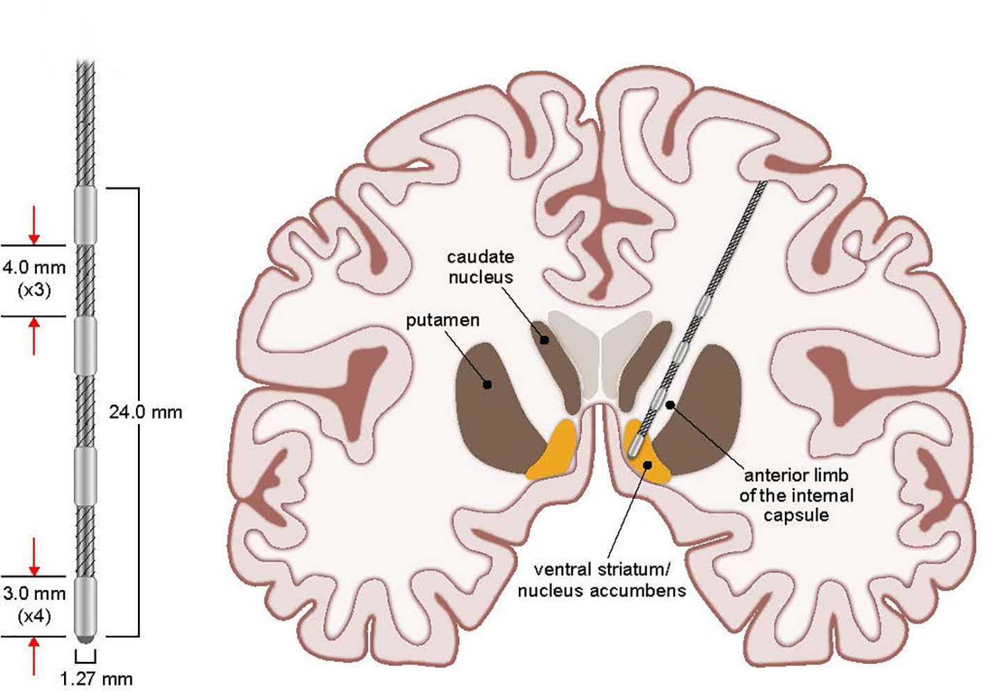 Frontiers Deep Brain Stimulation For Obsessive Compulsive Disorder A Long Term Naturalistic Follow Up Study In A Single Institution