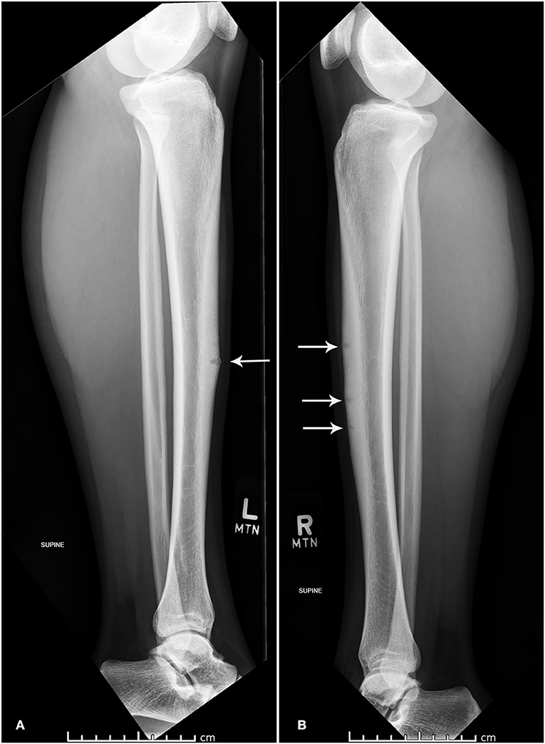 Frontiers | Concurrent Bilateral Anterior Tibial Stress Fractures and ...