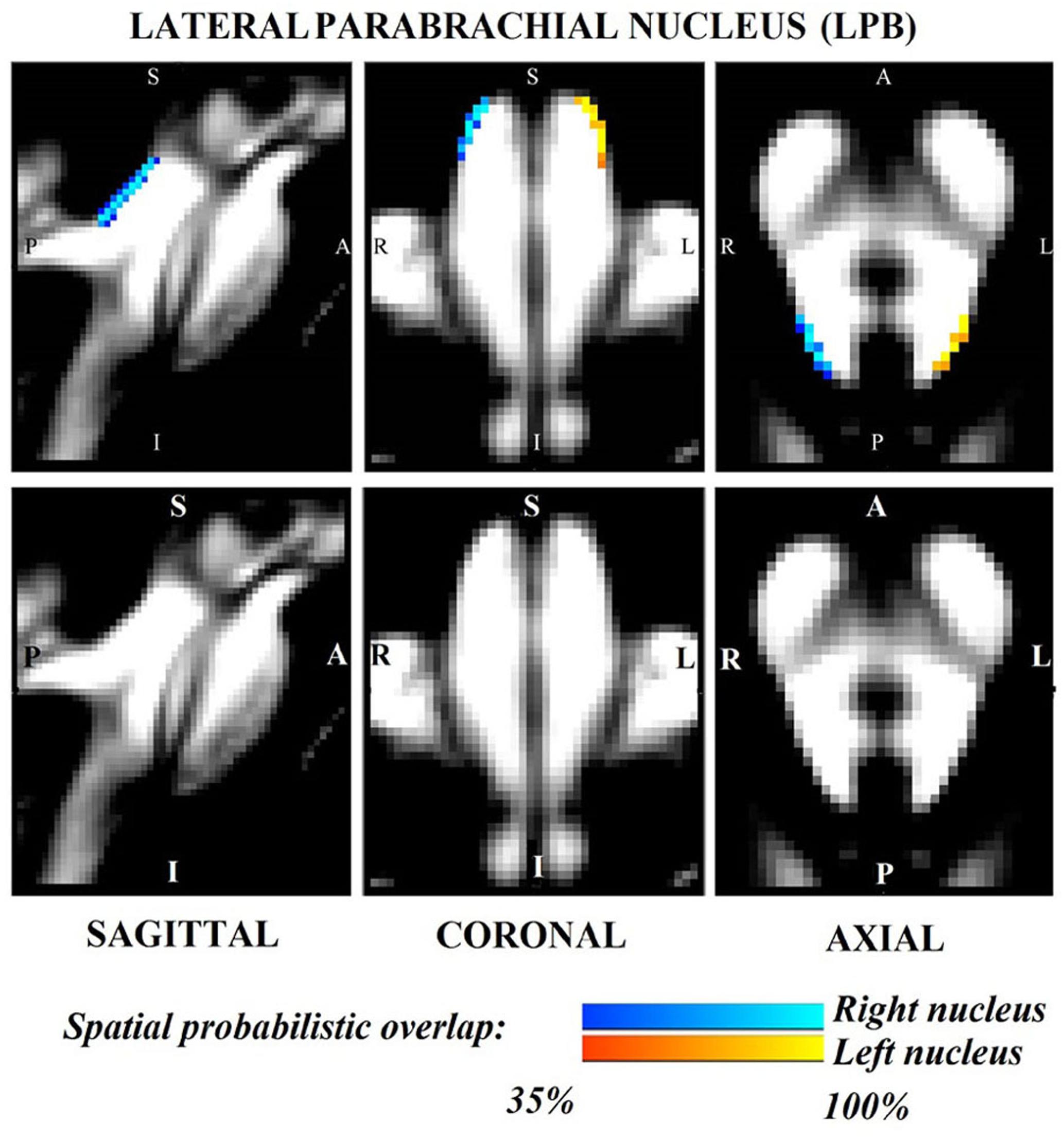 Frontiers Probabilistic Template Of The Lateral Parabrachial Nucleus Medial Parabrachial Nucleus Vestibular Nuclei Complex And Medullary Viscero Sensory Motor Nuclei Complex In Living Humans From 7 Tesla Mri Neuroscience