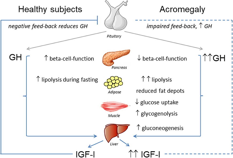 Acromegaly Diagram