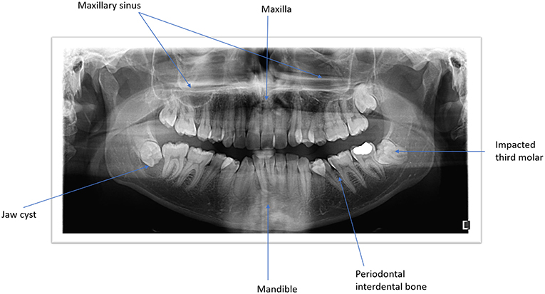 El rentat nasal