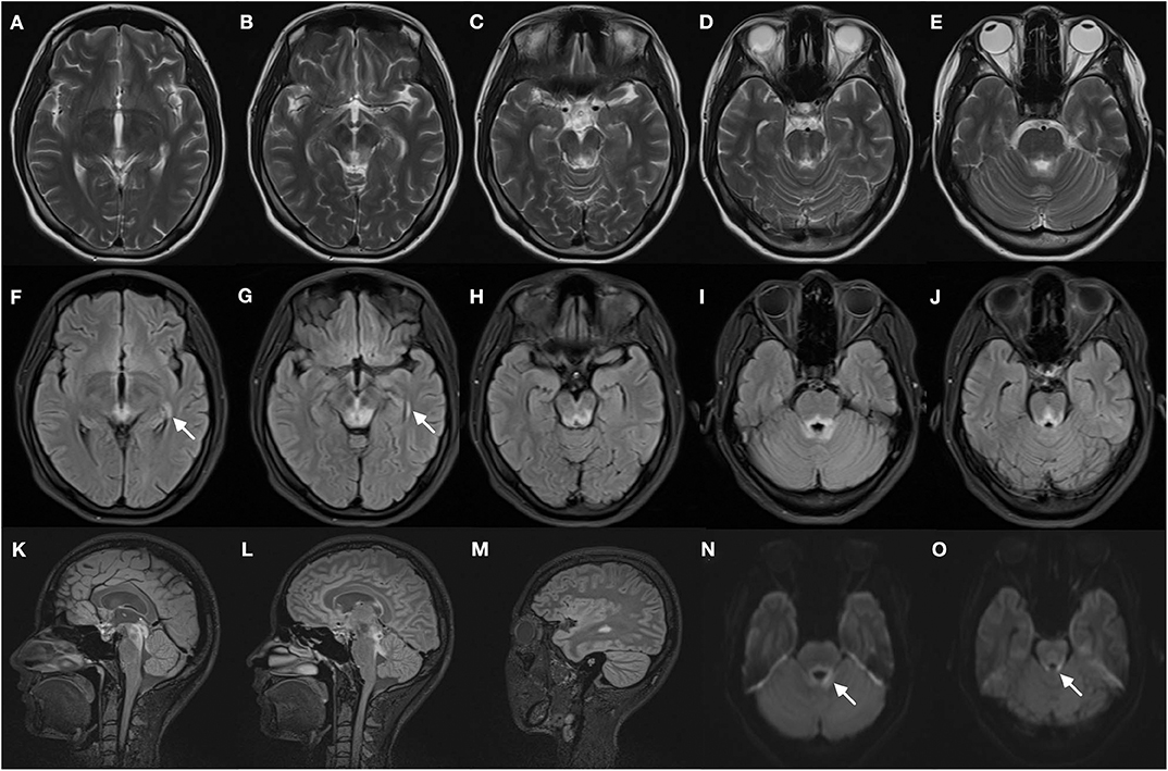 Frontiers | Classical Triad and Periventricular Lesions Do Not ...