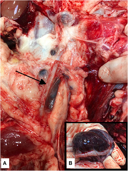 Frontiers  Fatal Ovarian Hemorrhage Associated With