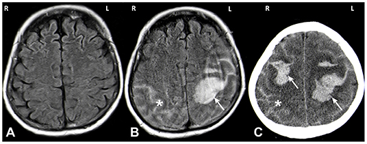 Frontiers | Spontaneous Intracerebral Hemorrhage Due to Delta Storage ...