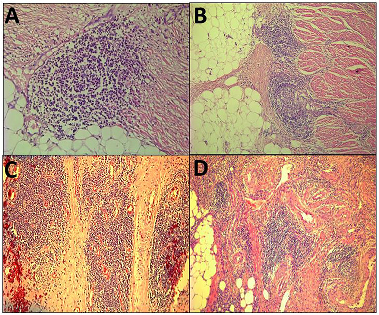 Frontiers The Crohn'sLike Lymphoid Reaction to Colorectal Cancer