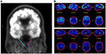 living with transient epileptic amnesia living with transient epileptic amnesia