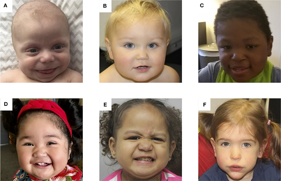 beckwith wiedemann syndrome adult