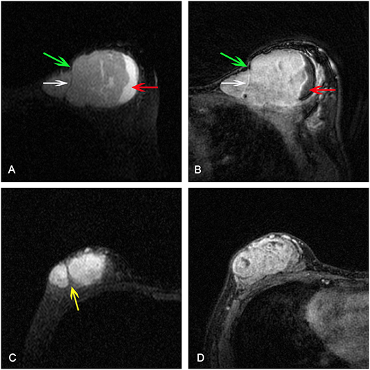 phyllodes tumor growth rate