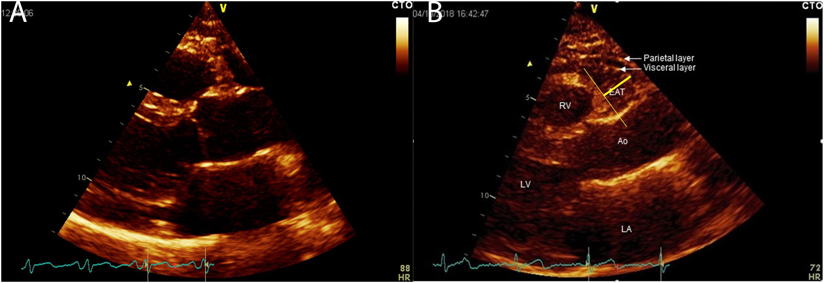 Frontiers  Deleterious Effects of Epicardial Adipose Tissue