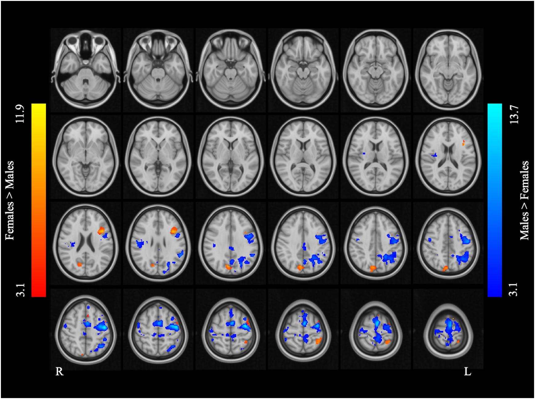 Frontiers Sex Effect On Presurgical Language Mapping In Patients With Free Download Nude Photo