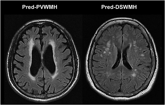 Subcortical sales white matter