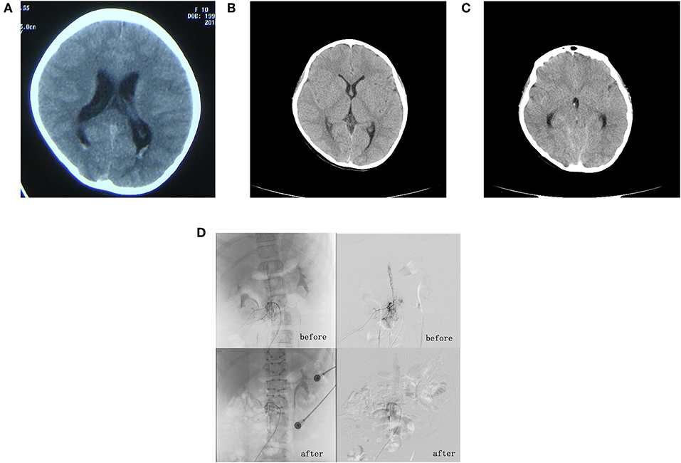 Frontiers - Cobb Syndrome Manifesting as Repetitive Seizures in a 10-Year-Old Girl: A Case ...