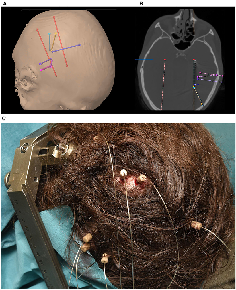 Frontiers | The Potential of Stereotactic-EEG for Brain-Computer ...