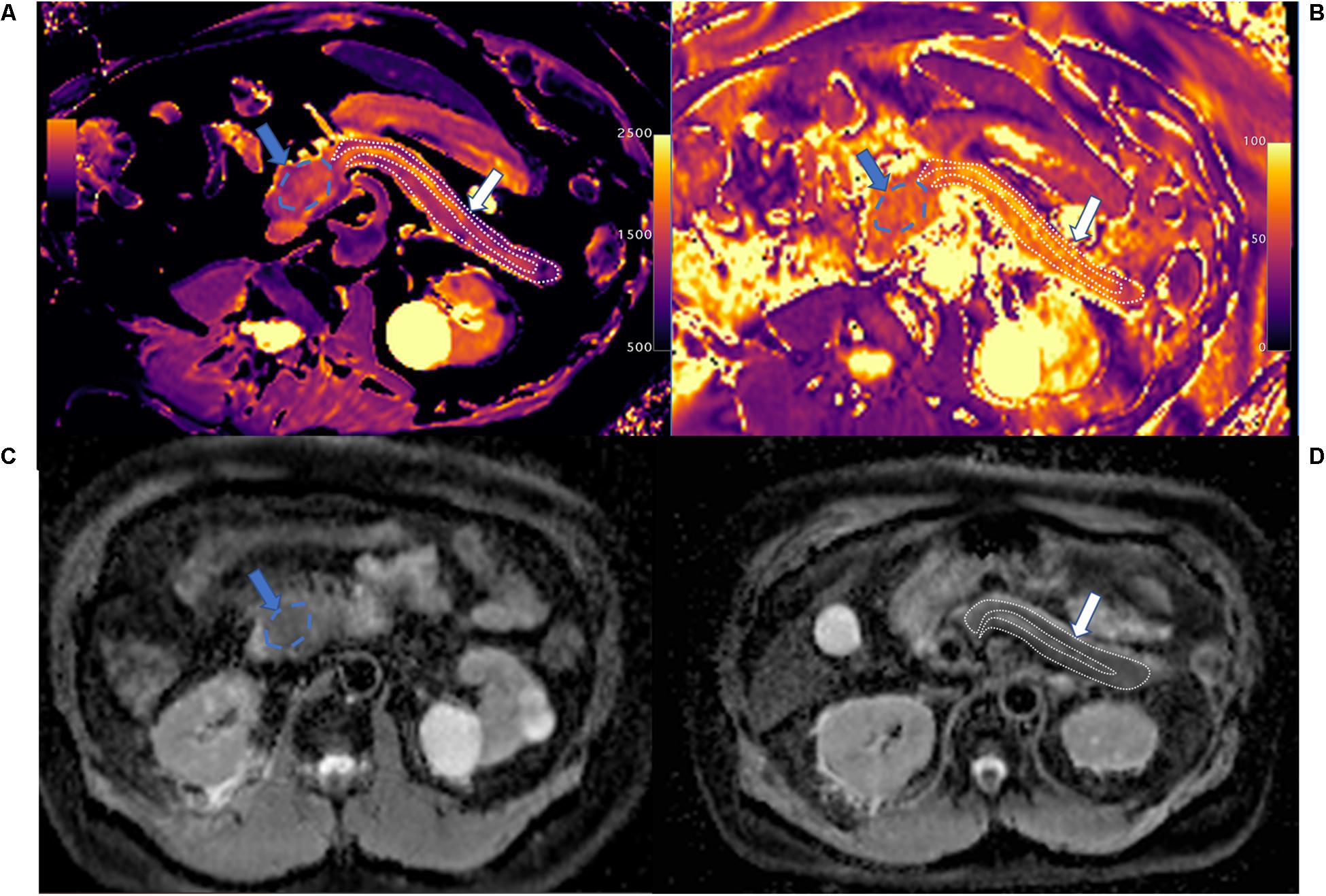 Frontiers  Multiparametric magnetic resonance imaging-derived