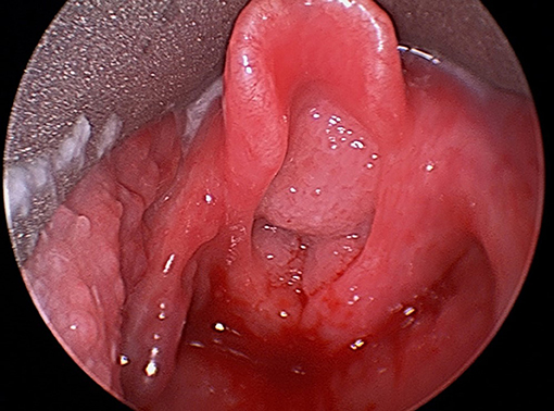 laryngeal papillomatosis lesion