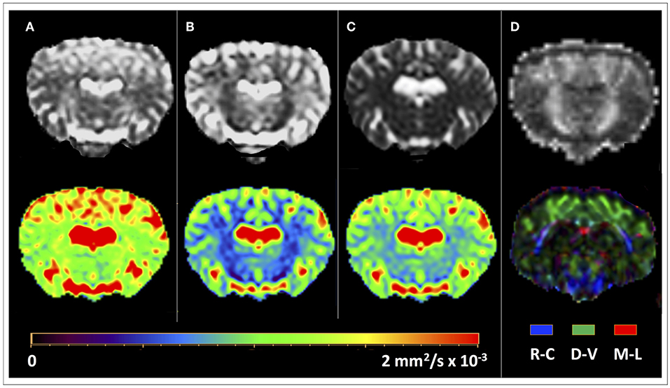 Measuring Connectivity in the Primary Visual Pathway in Human Albinism  Using Diffusion Tensor Imaging and Tractography